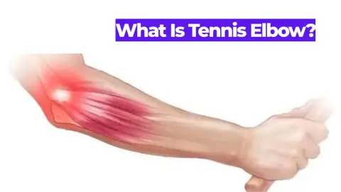 What Is Tennis Elbow? Causes, Symptoms, and Treatment
